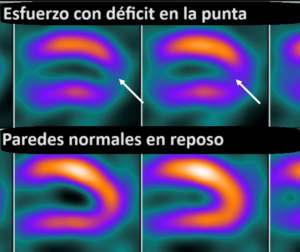 Gammagrafía miocárdica o MIBI con esfuerzo – Icardio