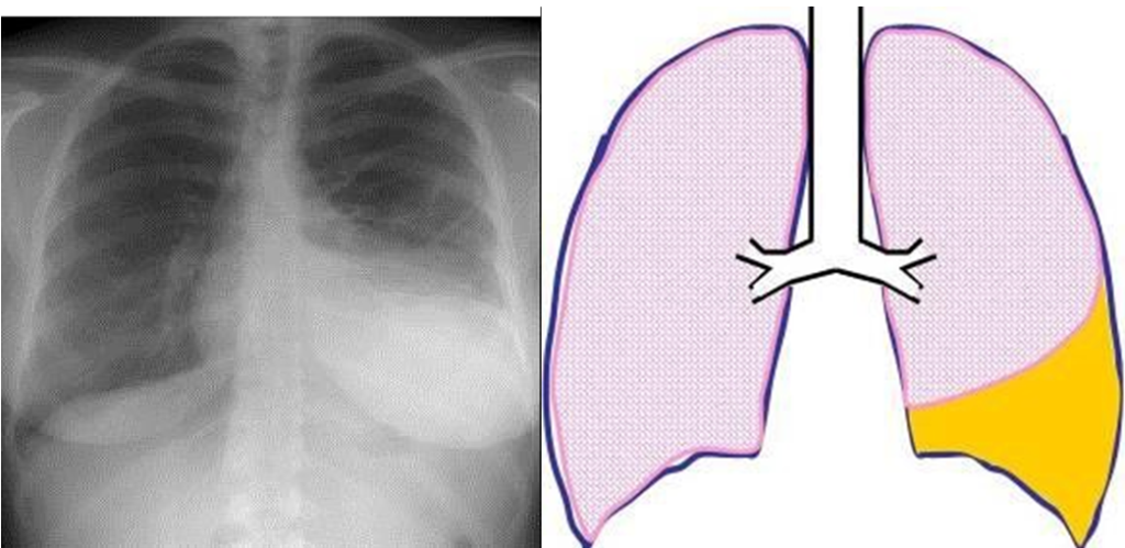 Agua «en» los pulmones, también conocida como edema pulmonar – Icardio