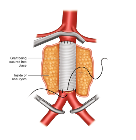 Abdominal Aortic Aneurysm – Icardio